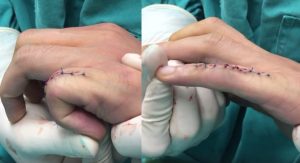 thay khớp liên đốt ngón