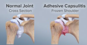 đông cứng khớp vai